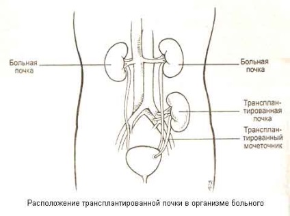 Transplantul de rinichi