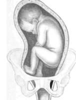 Труднощі прийняття пологів при тазовому передлежанні плода
