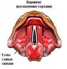 У дитини ларингіт, як його лікувати ефективно і швидко