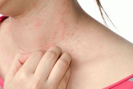 Urticaria la copil provoacă, forme și tratament