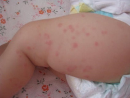 Urticaria la copil provoacă, forme și tratament