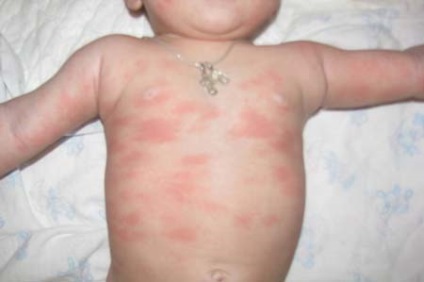 Urticaria la copil provoacă, forme și tratament