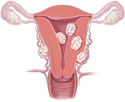 Varicoza ovariană la femei, tratamentul varicelor