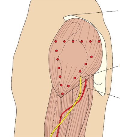 Injecții intramusculare