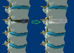 Implantarea implantului în regiunea lombară cu osteocondroză