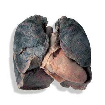 Захворювання легенів хронічні обструктивні - це