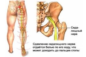 Tratamentul blocării nervului