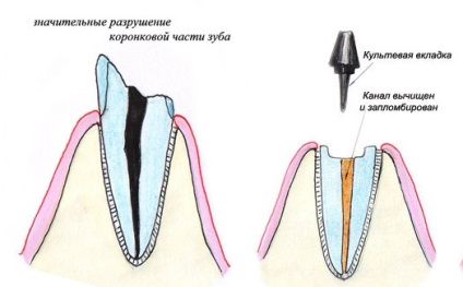 Зубні вкладки під коронки як роблять і ціна кульшових на передні зуби