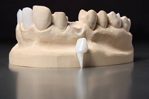 Зубні вкладки під коронки як роблять і ціна кульшових на передні зуби