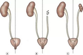 Ageneză la rinichi (dreapta, stânga) ce este, simptome, tratament