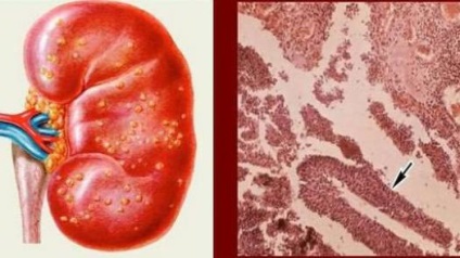 Агенезія нирки (правої, лівої) що це таке, симптоми, лікування