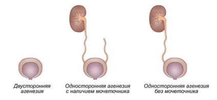 Агенезія нирки - види і особливості патології