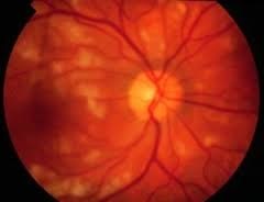 Angiopatia vaselor retinale la copii - așa cum s-a manifestat, și pericolul unei astfel de boli