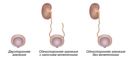 Aplazie și ageneză a cauzelor de rinichi din stânga și dreapta, tratament și prevenire