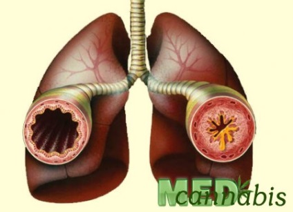 Tratamentul cu canabis care susține astm bronșic, cannabis med