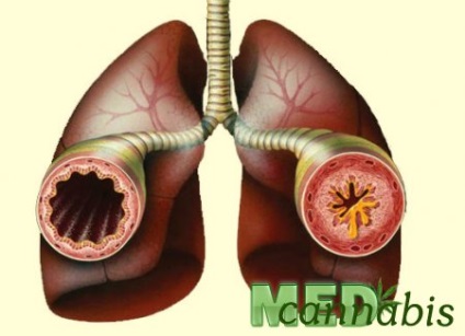 Астма - підтримуючу терапію каннабісом, med cannabis