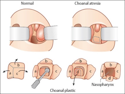 Atresia khohan - simptome, cauze, diagnostic, tratament și prevenire