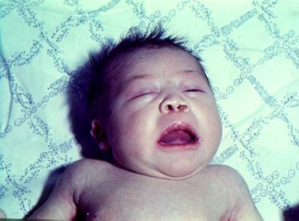 Atresia khohan simptome, semne, diagnostic și tratament (atrezia canan poate) Atresia khohan simptome, semne, diagnostic și tratament