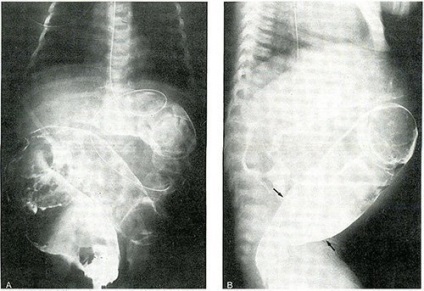 Boala lui Hirschsprung