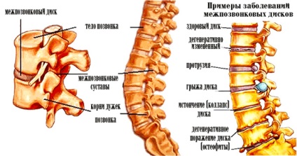 Болі в хребті в поперековому відділі - причини, лікування, чому болить хребет в області