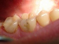 Біль в зубі після лікування карієсу, після лікування болить зуб