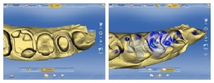 Суцільнокерамічні коронки cerec в Краснодарі, клініка Добринінський