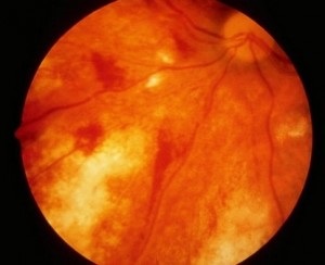 цитомегаловирусен ретинит