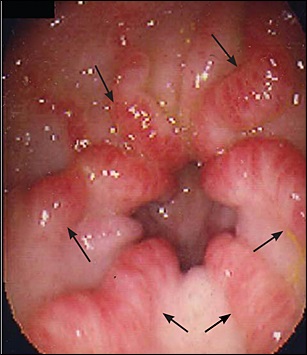 Diagnosticul sângerării gastrointestinale latente