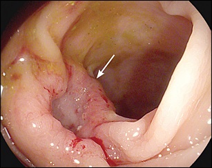 Diagnosticul sângerării gastrointestinale latente