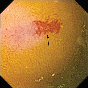 Diagnosticul sângerării gastrointestinale latente