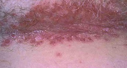 Eczeme simptome, cauze și tratament