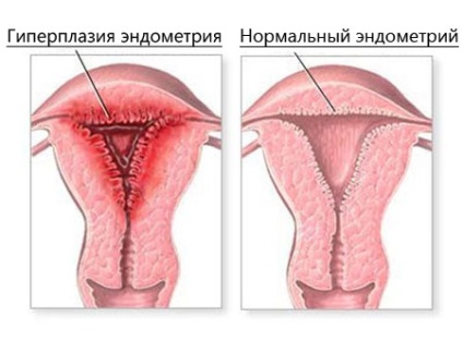 Ендометрит лікування і симптоми, хронічний і гострий ендометрит