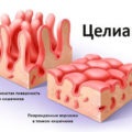 Eroziunea cauzată de stomac, metoda de tratament
