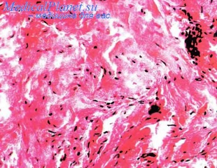 Fibroma ínhüvely (fibroma) Fibroma az ínhüvely