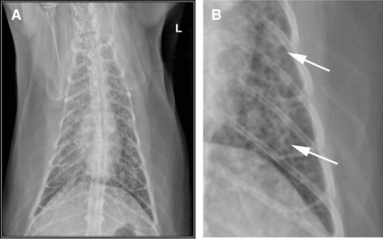 Fibroza pisicilor ușoare X-ray și caracteristicile histopatologice ale nouă pacienți,