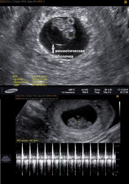Fotografie de uzi în timpul sarcinii, fotografie a fătului cu uzi în timpul sarcinii