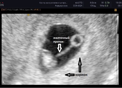 Fényképek ultrahang terhesség alatt, ultrahang képet a magzat a terhesség alatt