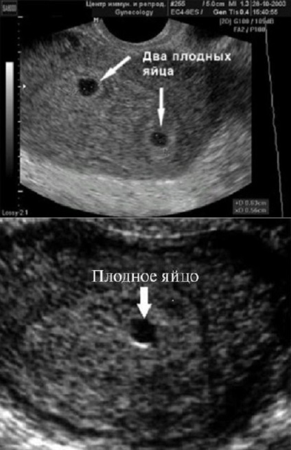 Фото узі при вагітності, фото плода при УЗД під час вагітності