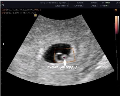 Fényképek ultrahang terhesség alatt, ultrahang képet a magzat a terhesség alatt