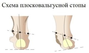 Гімнастика для Вальгусний стоп і x образних ніг у дітей