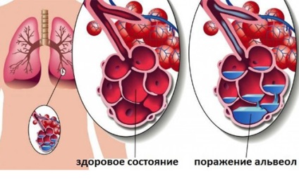 Гірчичники при кашлі дітям принцип дії і ефективність