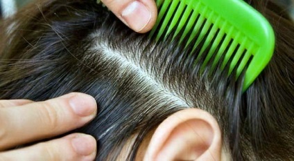 Грибок шкіри голови фото, симптоми лікування волосистої частини народними засобами