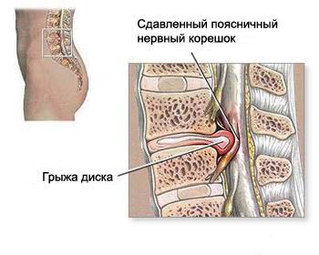 Disc herniat