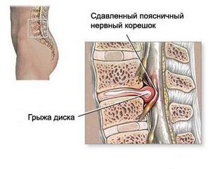 Herniated disc (tratament)