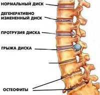 Дискова херния (лечение)