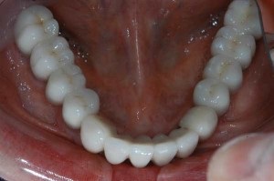 Implantarea cu atrofie mandibulară - dentas dentar stomatologie dentară