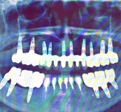 Implantarea dinților în tsao la un preț atractiv pentru tine, clinica dentară 
