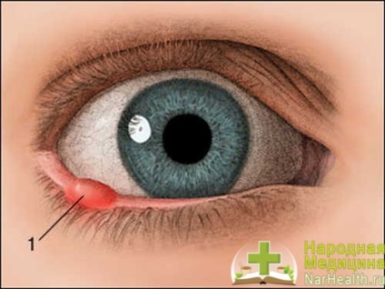 Infarctul cauzat de ochi, simptomele caracteristice, consecințele și metodele de bază ale diagnosticului