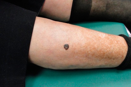 Informații despre melanom pe degetul și pielea piciorului