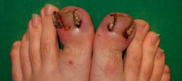 Інформація про меланому на пальці і шкірі ноги